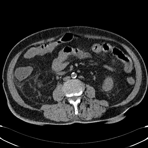 Acute appendicitis (Radiopaedia 58627-65818 Axial non-contrast 47).jpg