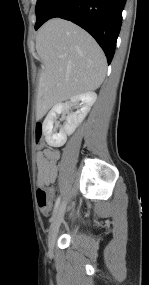 Acute appendicitis (Radiopaedia 62608-70901 Sagittal C+ portal venous phase 42).jpg