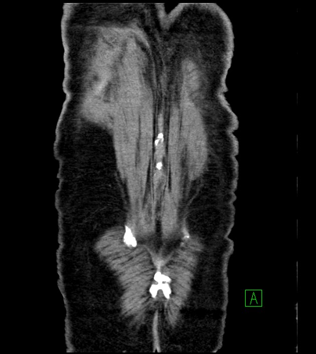 Acute arterial mesenteric ischemia (Radiopaedia 78238-90828 Coronal C+ portal venous phase 85).jpg