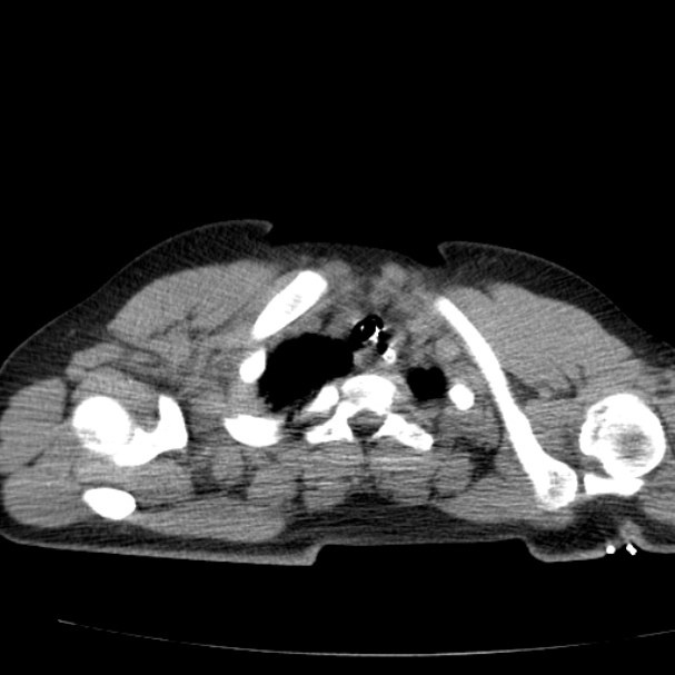 Acute aspiration pneumonitis (Radiopaedia 33605-34703 Axial non-contrast 20).jpg