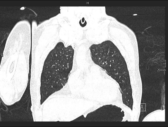 Acute aspiration pneumonitis (Radiopaedia 55642-62166 Coronal lung window 23).jpg