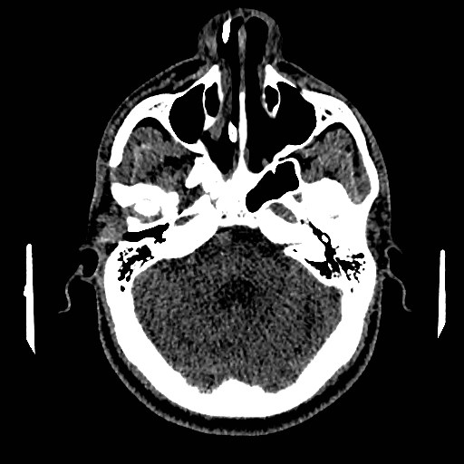 Acute basilar artery occlusion (Radiopaedia 43582-46985 Axial non-contrast 54).jpg