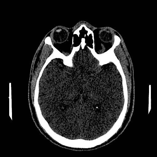 Acute basilar artery occlusion (Radiopaedia 43582-46985 Axial non-contrast 87).jpg