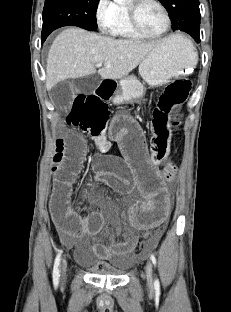 Acute bowel ischemia (Radiopaedia 87695-104114 Coronal C+ portal venous phase 144).jpg
