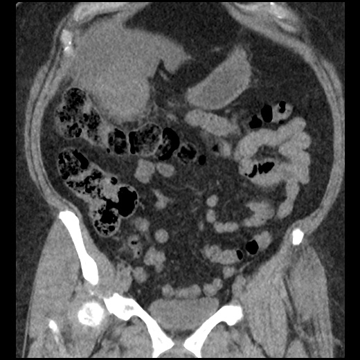 Acute cholecystitis and ureteric colic (Radiopaedia 42330-45444 Coronal prone 37).jpg