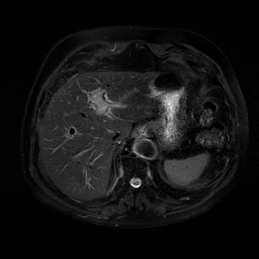 File:Acute cholecystitis complicated by pylephlebitis (Radiopaedia 65782-74915 Axial T2 fat sat 12).jpg