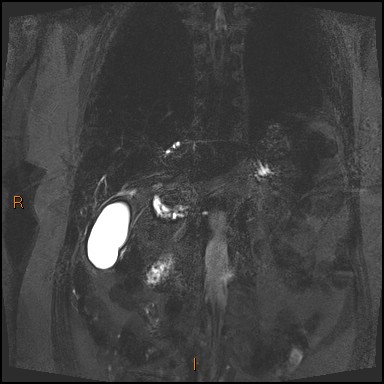 File:Acute cholecystitis with gallbladder neck calculus (Radiopaedia 42795-45971 Coronal Turbo spin echo 36).jpg
