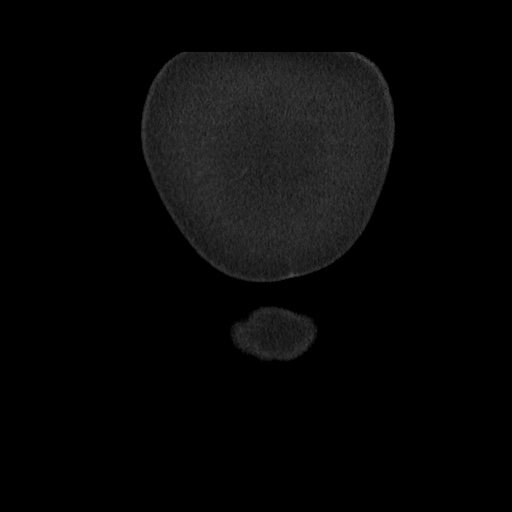 File:Acute cholecystitis with tensile fundus sign (Radiopaedia 71394-81723 Coronal non-contrast 12).jpg