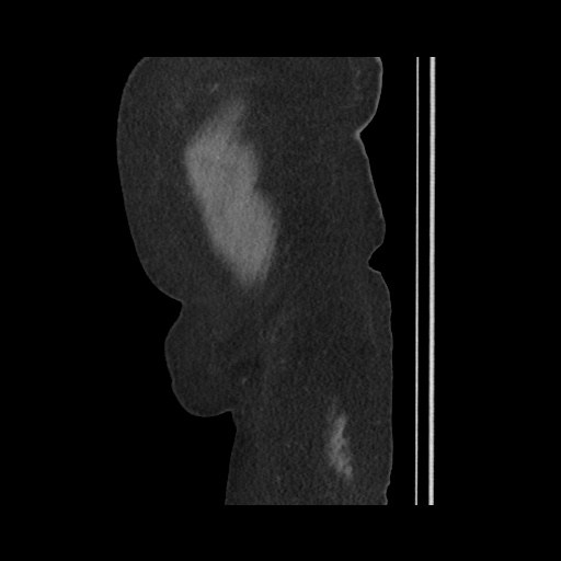 Acute cholecystitis with tensile fundus sign (Radiopaedia 71394-81723 Sagittal non-contrast 155).jpg