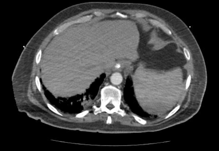 Acute cor pulmonale (ultrasound) (Radiopaedia 83508-98818 Axial C+ CTPA 71).jpg