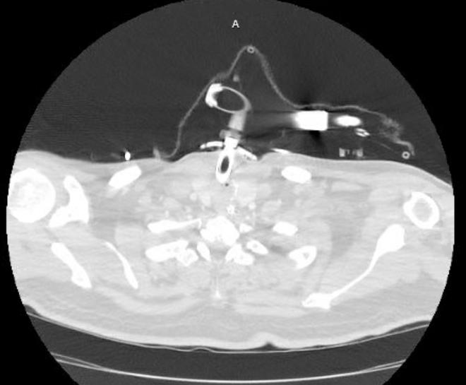 Acute cor pulmonale (ultrasound) (Radiopaedia 83508-98818 Axial lung window 1).jpg