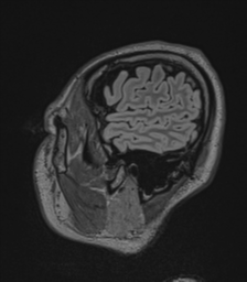 Acute disseminated encephalomyelitis (ADEM)- Anti-NMDA receptor encephalitis (Radiopaedia 54920-61201 Sagittal FLAIR 17).png