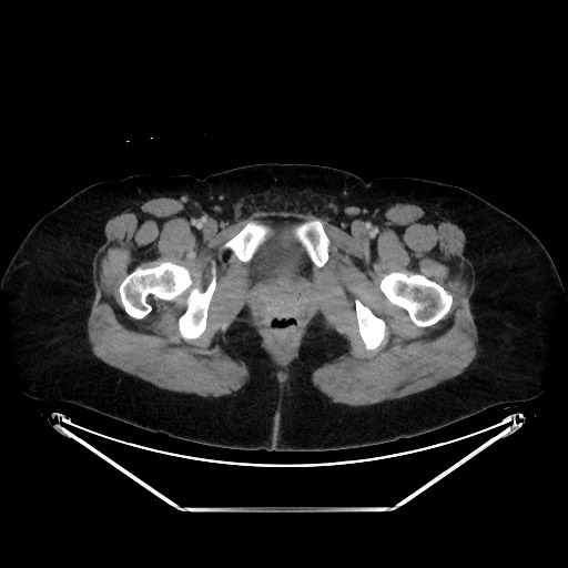 Acute diverticulitis - transverse colon (Radiopaedia 87063-103327 Axial C+ portal venous phase 168).jpg