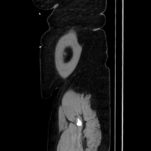 Acute diverticulitis - transverse colon (Radiopaedia 87063-103327 Sagittal C+ portal venous phase 198).jpg