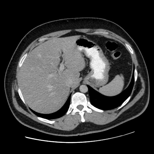 File:Acute diverticulitis with localized perforation (Radiopaedia 41296-44113 Axial C+ portal venous phase 20).jpg
