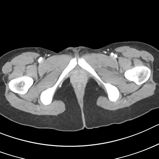 Acute gangrenous appendicitis with perforation (Radiopaedia 40152-42662 Axial C+ portal venous phase 80).png