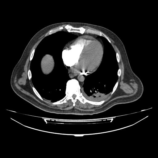 Acute heart failure (CT) (Radiopaedia 79835-93075 Axial C+ arterial phase 38).jpg
