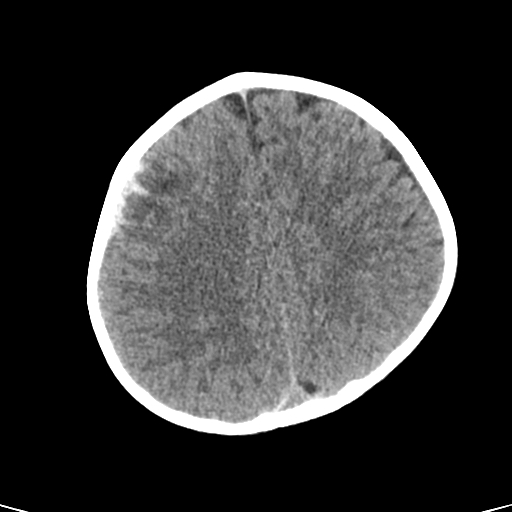 File:Acute hemorrhagic contusion (Radiopaedia 63660-72336 Axial non-contrast 32).jpg