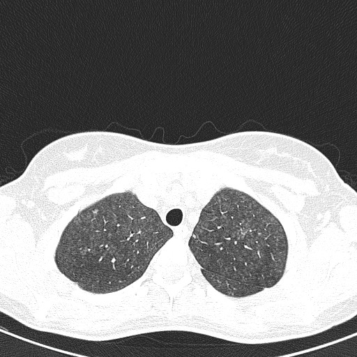 File:Acute hypersensitivity pneumonitis (Radiopaedia 85293-100870 Axial lung window 19).jpg