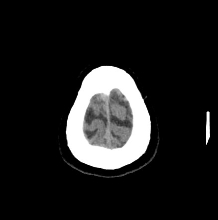 Acute internal carotid artery dissection (Radiopaedia 53541-59558 Axial non-contrast 58).jpg