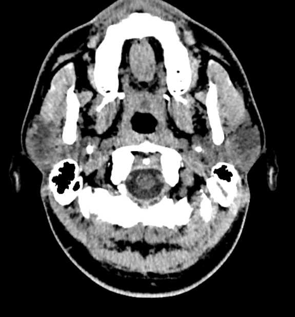 Acute ischemic stroke - posterior circulation territory (Radiopaedia 77670-89881 non-contrast 2).jpg