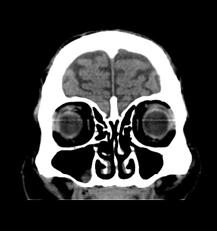 Acute left anterior cerebral artery territory infarction (Radiopaedia 51785-57578 Coronal non-contrast 10).jpg