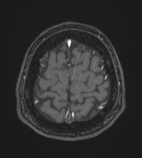 Acute left middle cerebral artery territory infarct with clot retrieval (Radiopaedia 47732-52433 Axial MRA 60).png