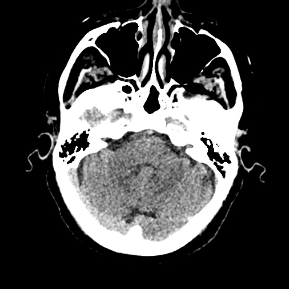 Acute middle cerebral artery territory infarct (Radiopaedia 52380-58283 Axial non-contrast 22).jpg