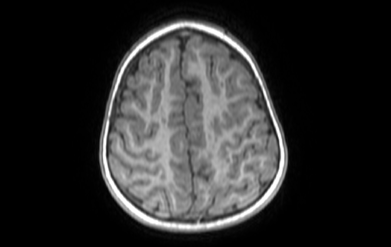 File:Acute necrotizing encephalitis of childhood (Radiopaedia 67356-76737 Axial T1 19).jpg
