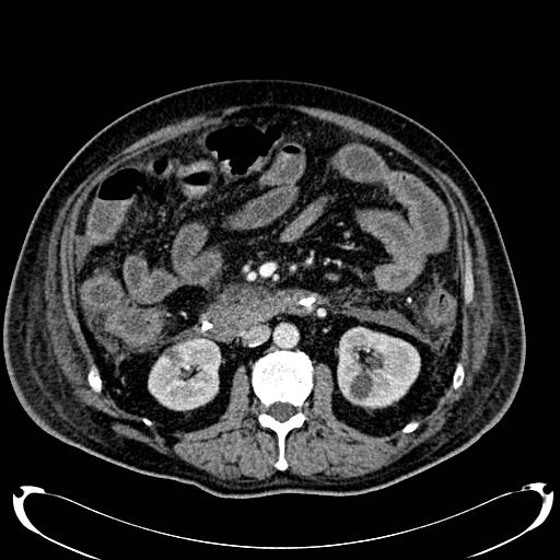 Acute pancreatic necrosis (Radiopaedia 13560-18500 Axial C+ portal venous phase 76).jpg