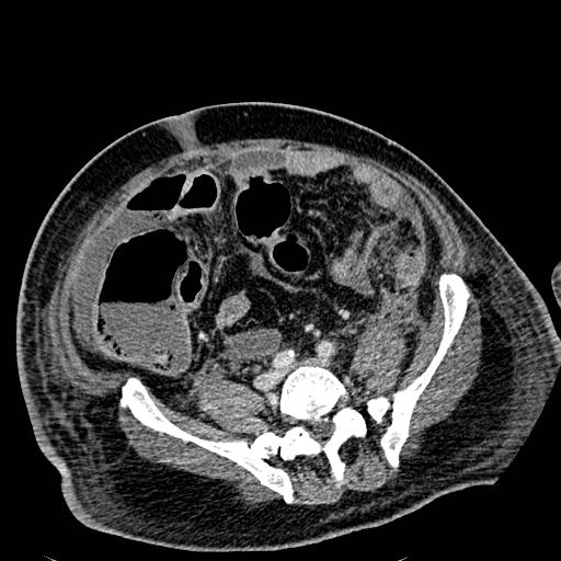 Acute pancreatic necrosis (Radiopaedia 13560-18501 Axial C+ portal venous phase 102).jpg
