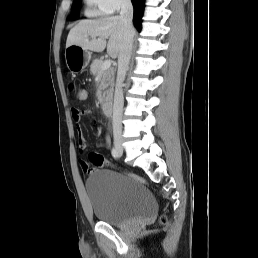 Acute pancreatitis (Radiopaedia 22572-22596 Sagittal C+ portal venous phase 25).jpg