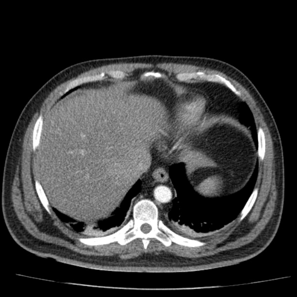 Acute pancreatitis (Radiopaedia 26663-26813 Axial C+ arterial phase 16).jpg