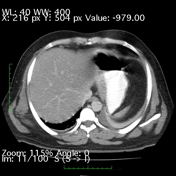 File:Acute pancreatitis (Radiopaedia 34043-35276 Axial C+ portal venous phase 11).jpg