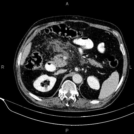 Acute pancreatitis (Radiopaedia 85146-100701 Axial C+ portal venous phase 25).jpg