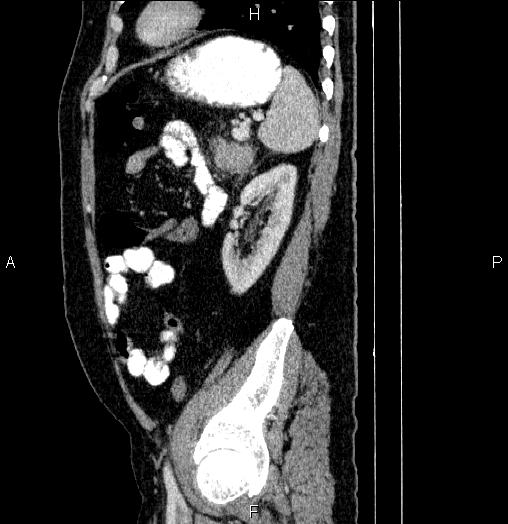 Acute pancreatitis (Radiopaedia 85390-101010 Sagittal C+ portal venous phase 78).jpg