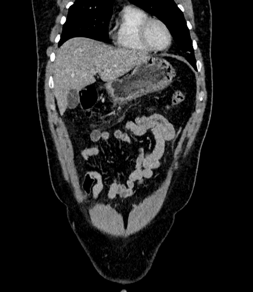Acute pancreatitis (Radiopaedia 87428-103757 Coronal C+ portal venous phase 22).jpg