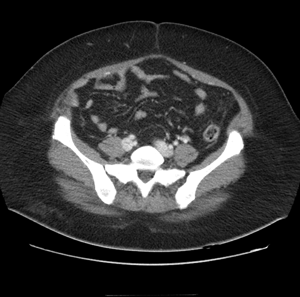 File:Acute pancreatitis - Balthazar E (Radiopaedia 29016-29377 Axial C+ portal venous phase 52).png