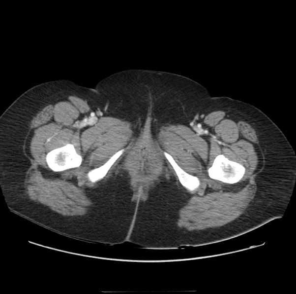 Acute pancreatitis - Balthazar E (Radiopaedia 29016-29377 Axial C+ portal venous phase 81).png