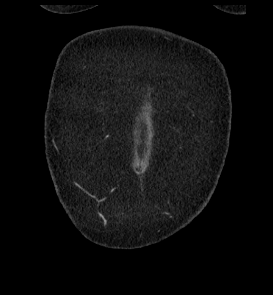 Acute pancreatitis - Balthazar E (Radiopaedia 29016-29377 Coronal C+ portal venous phase 9).png