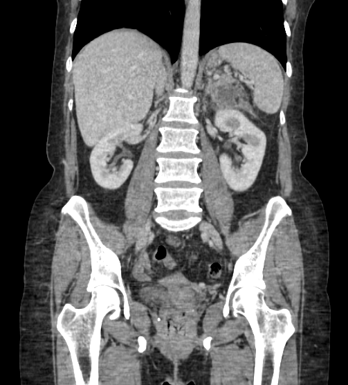 Acute pancreatitis - Balthazar E - post ERCP (Radiopaedia 27562-27772 Coronal C+ portal venous phase 52).png
