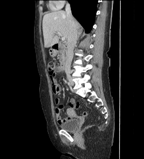 File:Acute pancreatitis - Balthazar E - post ERCP (Radiopaedia 27562-27772 Sagittal C+ portal venous phase 55).png