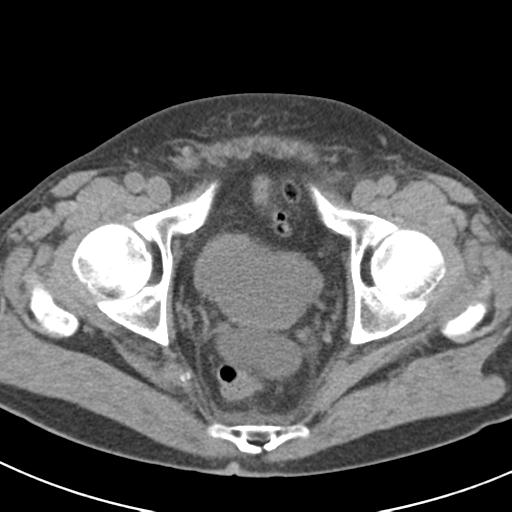 File:Acute pancreatitis and walled-off necrosis (Radiopaedia 29888-30403 Axial non-contrast 72).jpg