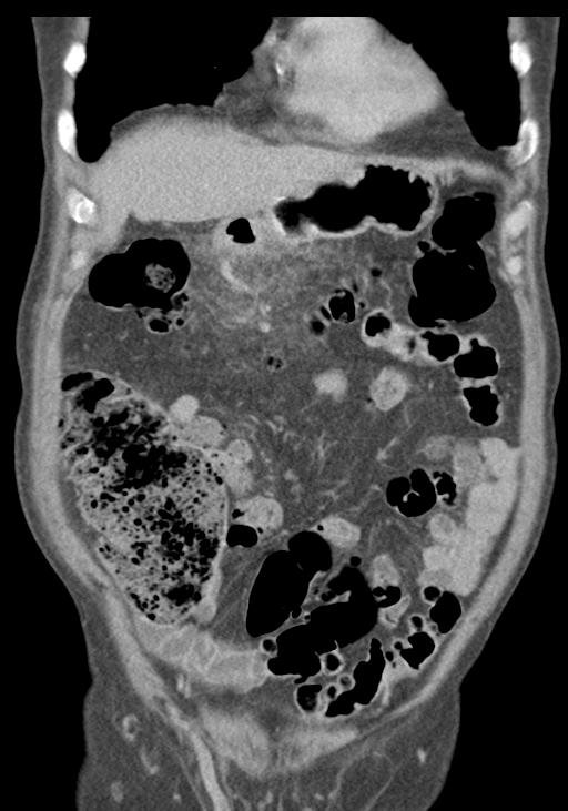 Acute pancreatitis and walled-off necrosis (Radiopaedia 29888-30403 E 17).jpg