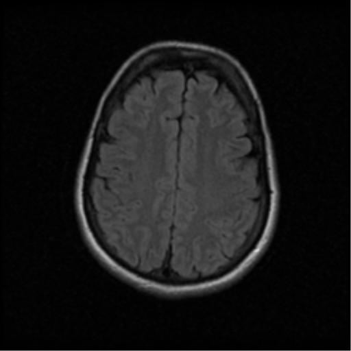 File:Acute pontine infarct from vertebral artery dissection (Radiopaedia 34111-35370 Axial FLAIR 16).png