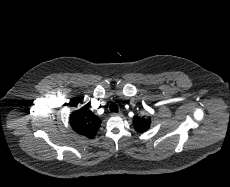 Acute pulmonary embolism with pulmonary infarcts (Radiopaedia 77688-89908 Axial C+ CTPA 3).jpg