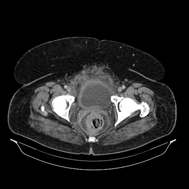 Acute pyelonephritis (Radiopaedia 25657-25837 Axial renal parenchymal phase 76).jpg