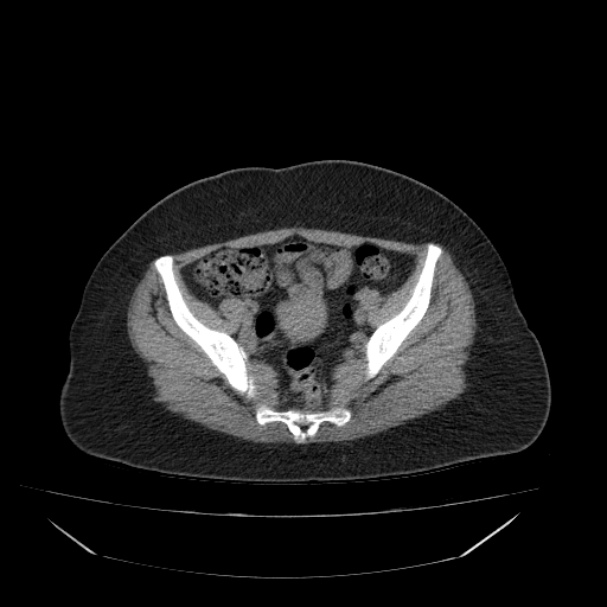 Acute pyelonephritis (Radiopaedia 33397-34434 Axial non-contrast 65).jpg