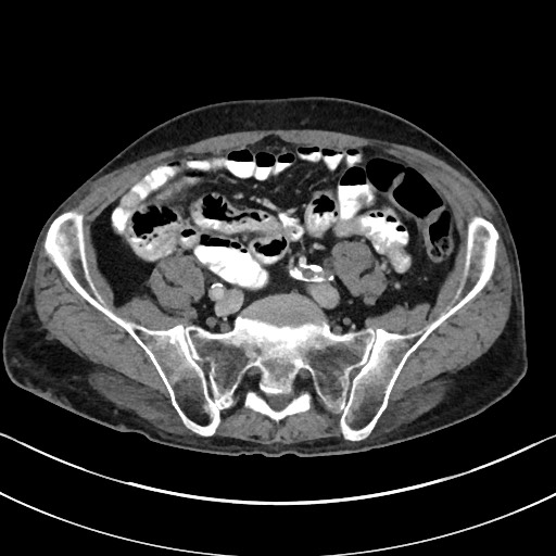 Acute renal infarction - rim capsular enhancement (Radiopaedia 59833-67270 Axial C+ portal venous phase 71).jpg