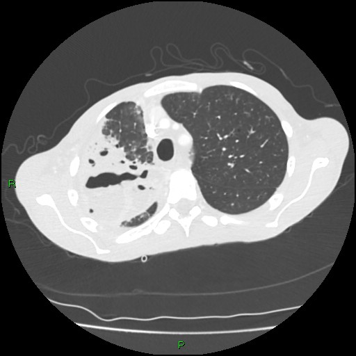 Acute right lung abscess (Radiopaedia 34806-36258 Axial lung window 46).jpg